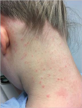 A 12 Year Old Girl With Scattered Erythematous Papules Pustules On Her