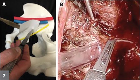 iliopectineal fascia