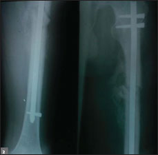 radiograph of left femur at 3 months postop