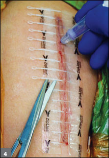 Application of skin adhesive