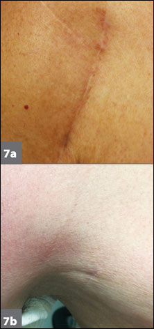 Incision closure 1 year after the technique