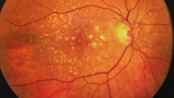 Neovascular age-related macular degeneration