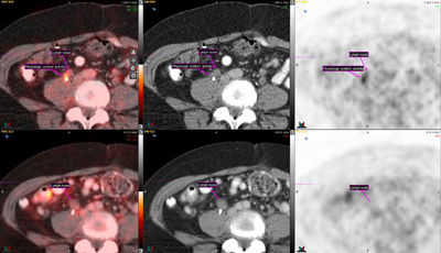 Figure 1. Follow-up restaging PET/CT demonstrates decreasing size and metabolic activity of a single residual right para-aortic lymph node (SUVmax, 2.8).