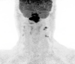  Figure 5: Maximum-intensity projection PET image globally shows the distribution of metabolically active disease in the neck, nasopharynx, and retropharyngeal and bilateral level II and III lymph nodes.