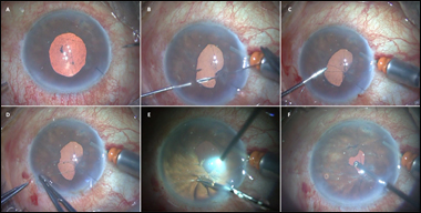 SFT for angle-closure glaucoma