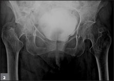 icd 10 code for right basicervical femoral neck fracture