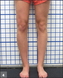 Valgus deformity and limb length discrepancy corrected